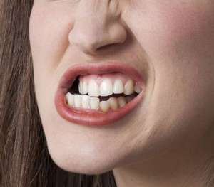Punya Kebiasaan Menggertakkan Gigi pada Saat Tidur? Ini Penyebabnya