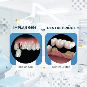 implan gigi dan dental bridge