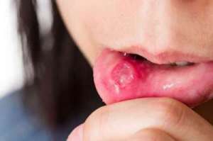 sariawan pada bibir