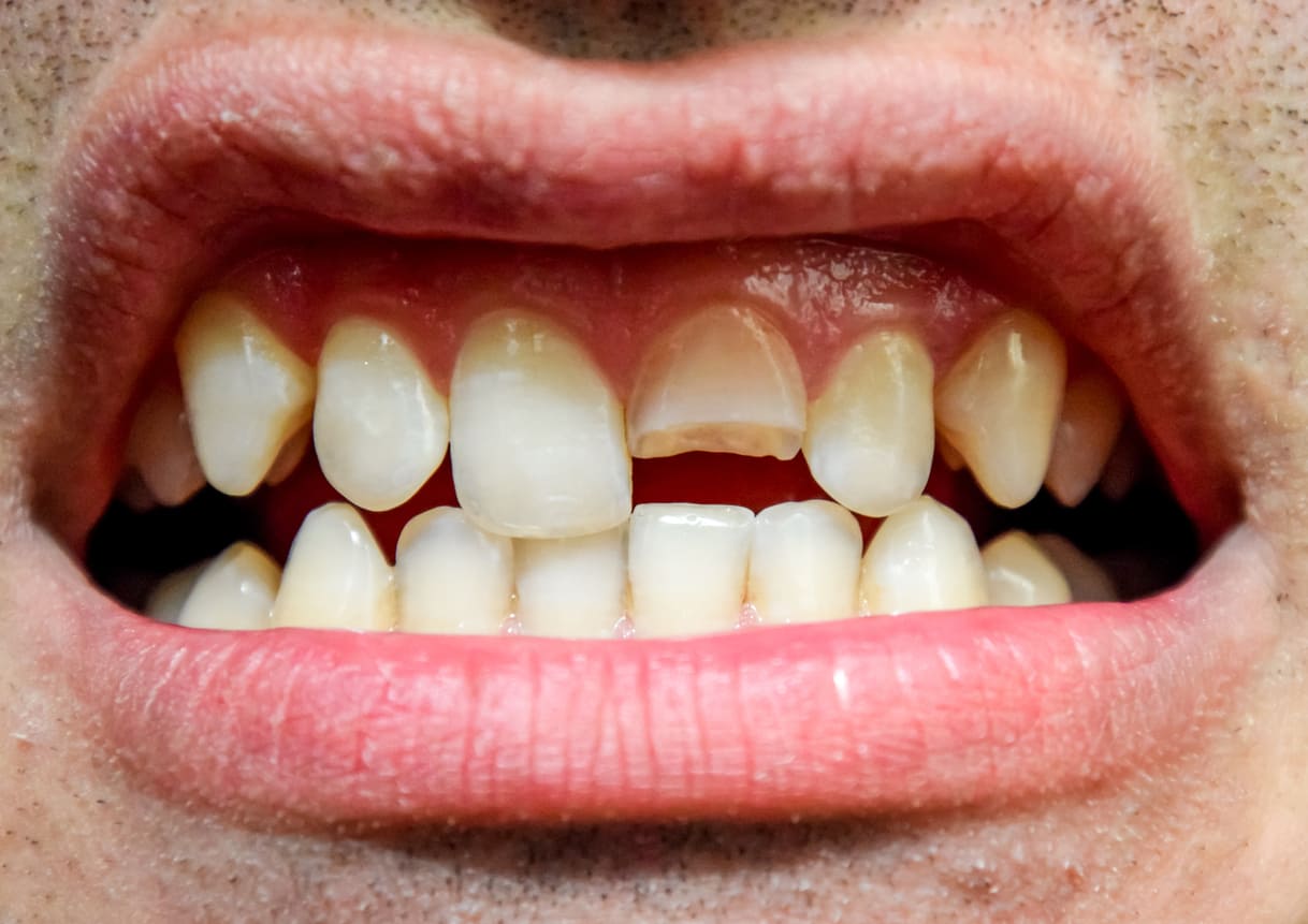 6.Gigi depan yang patah dan melibatkan sebagian kecil atau besar permukaan ...
