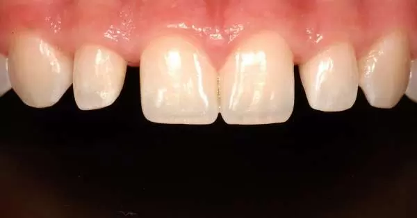 pasang behel gigi pada gigi yang bercelah