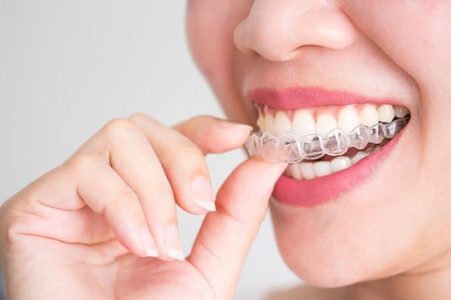 aligner gigi