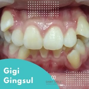 gigi gingsul