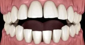 open bite
