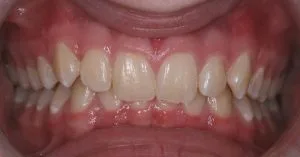 overbite adalah gigi atas yang terlalu menutupi gigi bawah