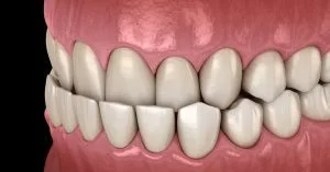 underbite