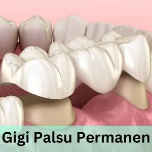 gigi palsu permanen