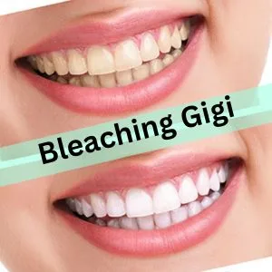 Bleaching Gigi