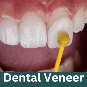 veneer gigi
