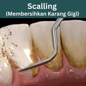 scalling surabaya