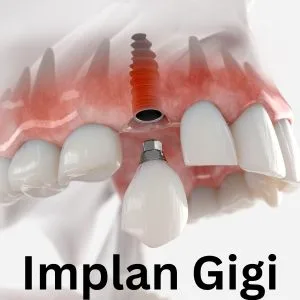 implan gigi