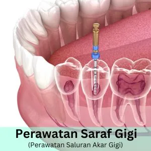 perawatan saraf gigi