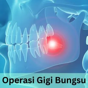 operasi gigi bungsu