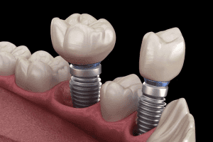 crown dental implant