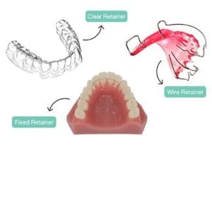 Retainer gigi