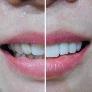 veneer gigi depan