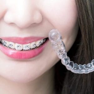 tips memakai kawat gigi