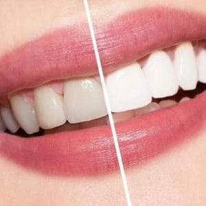 pantangan setelah bleaching gigi