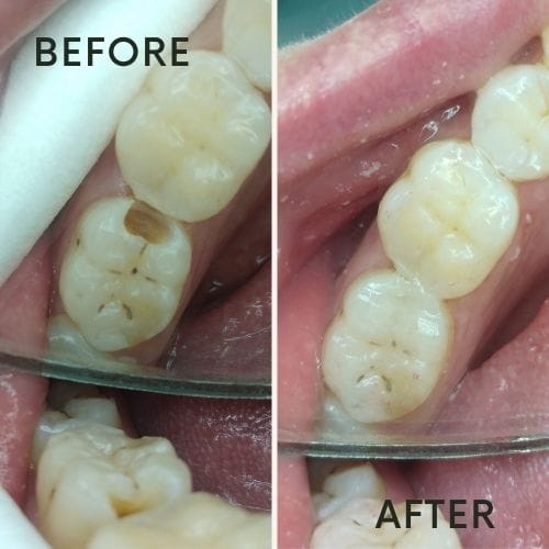 before after alexander