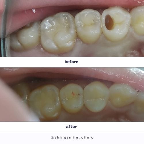 before after isadora