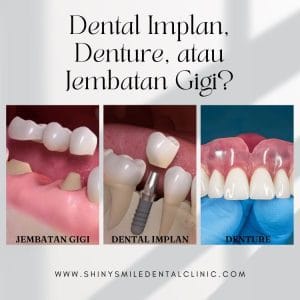 dental implant