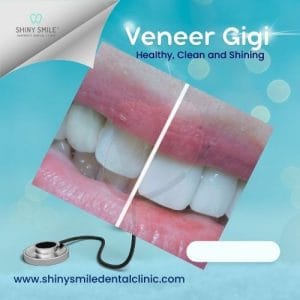 harga veneer gigi