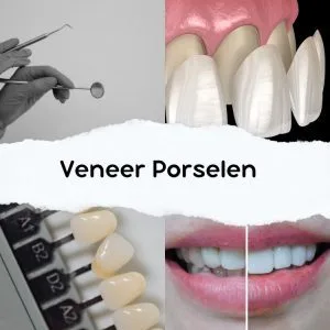 veneer porselen